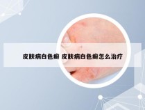 皮肤病白色癣 皮肤病白色癣怎么治疗