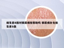 维生素B族对银屑病有帮助吗 银屑病补充维生素b族