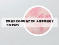 银屑病头皮不痒后能烫发吗 头部银屑病好了,可以烫头吗