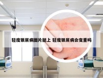 轻度银屑病图片腿上 轻度银屑病会变重吗