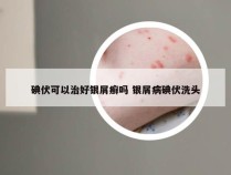 碘伏可以治好银屑癣吗 银屑病碘伏洗头