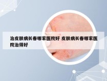 治皮肤病长春哪家医院好 皮肤病长春哪家医院治得好