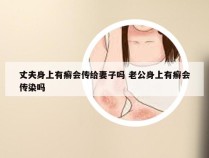 丈夫身上有癣会传给妻子吗 老公身上有癣会传染吗