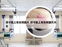 孩子腿上有白斑图片 孩子腿上有白斑图片大全