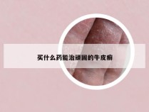 买什么药能治顽固的牛皮癣