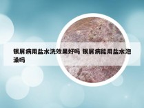 银屑病用盐水洗效果好吗 银屑病能用盐水泡澡吗