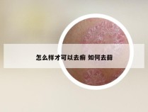 怎么样才可以去癣 如何去藓