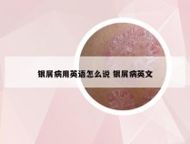 银屑病用英语怎么说 银屑病英文