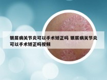 银屑病关节炎可以手术矫正吗 银屑病关节炎可以手术矫正吗视频