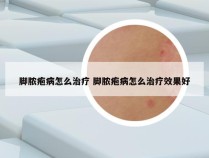 脚脓疱病怎么治疗 脚脓疱病怎么治疗效果好