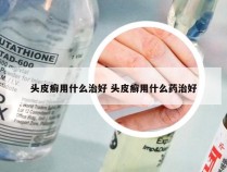 头皮癣用什么治好 头皮癣用什么药治好