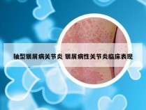 轴型银屑病关节炎 银屑病性关节炎临床表现