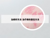 治癣好方法 治疗癣的最佳方法