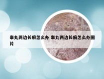 睾丸两边长癣怎么办 睾丸两边长癣怎么办图片