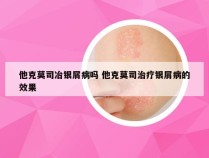 他克莫司冶银屑病吗 他克莫司治疗银屑病的效果