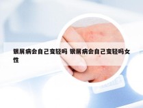 银屑病会自己变轻吗 银屑病会自己变轻吗女性