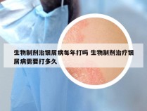 生物制剂治银屑病每年打吗 生物制剂治疗银屑病需要打多久