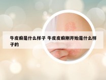 牛皮癣是什么样子 牛皮皮癣刚开始是什么样子的