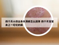 四个月小孩全身长满癣怎么回事 四个月宝宝身上一坨坨的癣