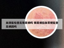 血液能检查出银屑病吗 银屑病验血常规能查出病因吗