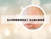 怎么判别银屑病消退了 怎么确认银屑病