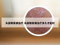 头部银屑病治疗 头部银屑病治疗多久才能好