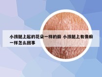 小孩腿上起的花朵一样的藓 小孩腿上有像癣一样怎么回事