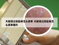 大腿挠过后起癣怎么回事 大腿挠过后起癣怎么回事图片