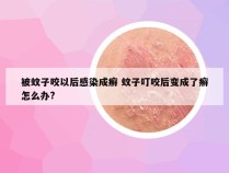 被蚊子咬以后感染成癣 蚊子叮咬后变成了癣怎么办?