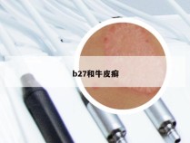 b27和牛皮癣