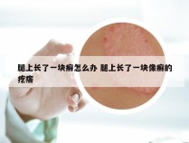 腿上长了一块癣怎么办 腿上长了一块像癣的疙瘩