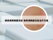 银屑病用胸腺五肽 银屑病胸腺五肽治疗方案