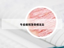 牛皮癣初发奇痒无比