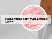 小儿腿上长癣是怎么回事 小儿腿上长癣是怎么回事啊