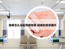 腿癣怎么治能彻底除根 腿癣的症状图片