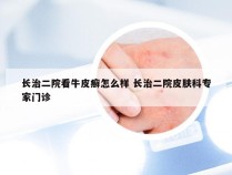 长治二院看牛皮癣怎么样 长治二院皮肤科专家门诊