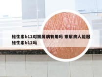 维生素b12对银屑病有用吗 银屑病人能服维生素b12吗