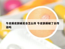 牛皮癣皮肤破皮会怎么样 牛皮肤癣破了会传染吗