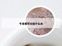 牛皮癣可以挂什么水