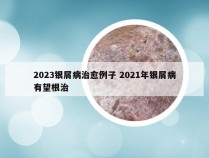 2023银屑病治愈例子 2021年银屑病有望根治