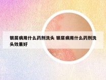 银屑病用什么药剂洗头 银屑病用什么药剂洗头效果好