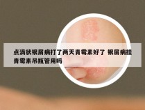 点滴状银屑病打了两天青霉素好了 银屑病挂青霉素吊瓶管用吗