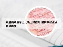 银屑病红点早上比晚上好些吗 银屑病红点点越来越多