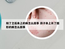 阳了之后身上的癣怎么回事 孩子身上长了圆形的癣怎么回事