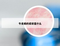 牛皮癣的症状是什么