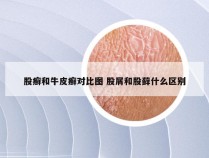 股癣和牛皮癣对比图 股屑和股藓什么区别