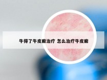 牛得了牛皮廨治疗 怎么治疗牛皮廨