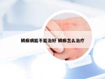 鳞癣病能不能治好 鳞癣怎么治疗