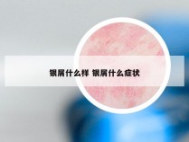 银屑什么样 银屑什么症状