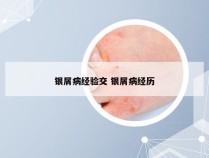 银屑病经验交 银屑病经历